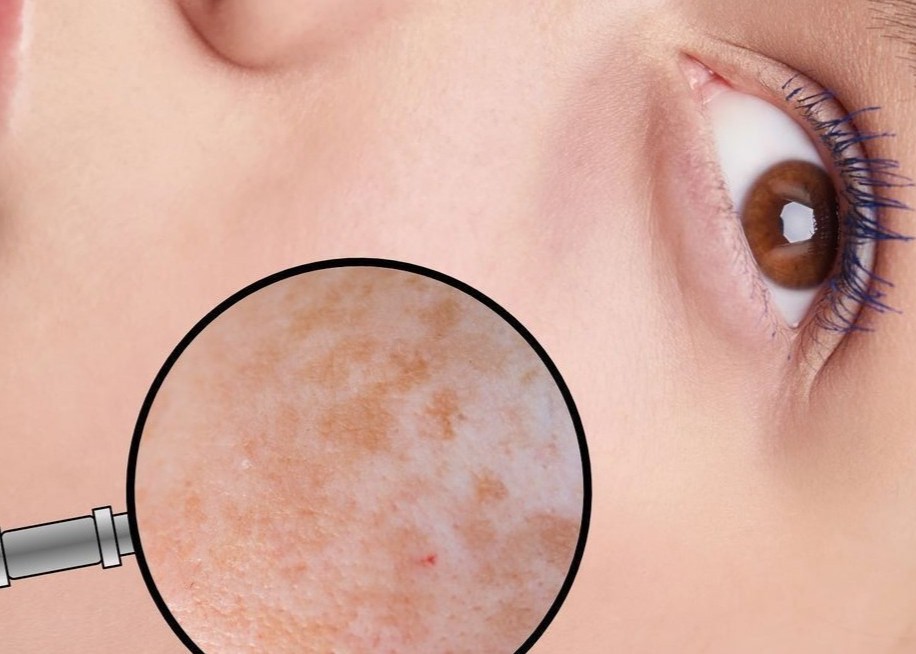 Melasma Removal