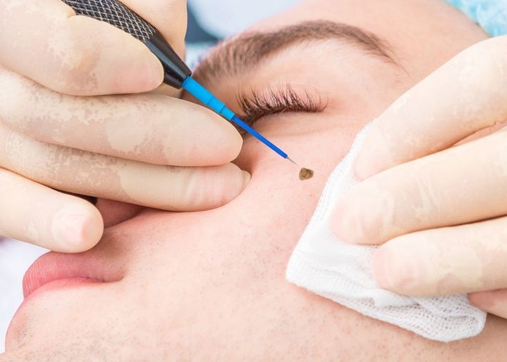 Warts Removal Unlimited